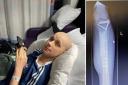 Jack lost his hair during months of chemotherapy and, right, an xc-ray of his leg showing the new bone and the screws holding it together