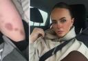 Caprice Glasspool (pictured, left, her injuries) is encouraging victims of domestic abuse to report crimes to police after she was hit by her partner