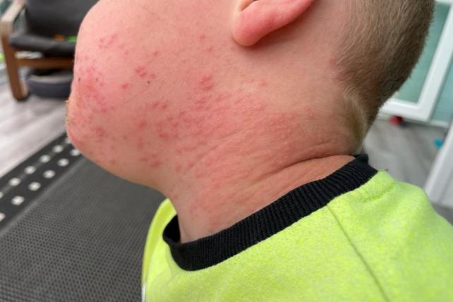 Caterpillar rash: Mum's warning to parents after brown tail moth leaves ...