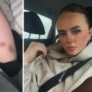 Caprice Glasspool (pictured, left, her injuries) is encouraging victims of domestic abuse to report crimes to police after she was hit by her partner