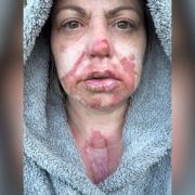 Marnie Hobbs was left with agonising second-degree burns after a tealight from Home Bargains exploded in her face